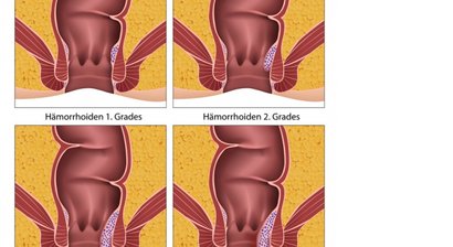Hämorrhoiden, Fissuren, Fisteln sanfte und schonende Therapieverfahren