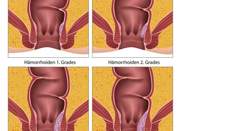 Hämorrhoiden, Fissuren, Fisteln sanfte und schonende Therapieverfahren - OA Dr. Frank Marschall - Allgemeinchirurg/Viszeralchirurg Wien 1090
