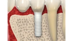 Implantologie -