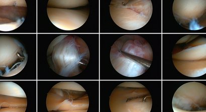 Arthroskopie (Knie, Schulter)