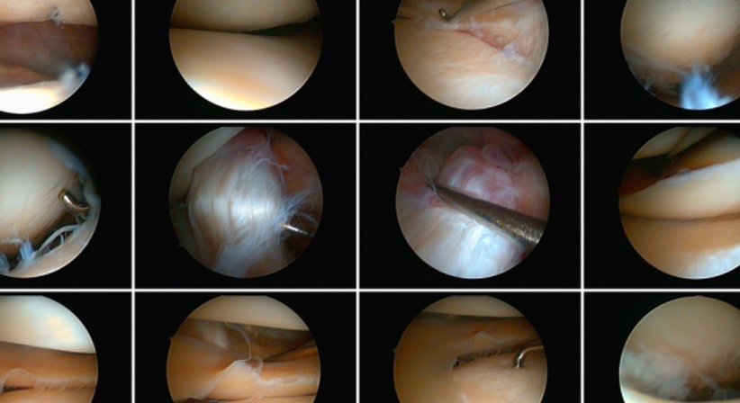 Arthroskopie (Knie, Schulter) - Univ.- Prof. Dr. Alexander Giurea - Orthopäde Wien 1090