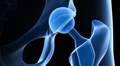 Hüftprothese (Hüftarthrose/ Coxarthrose) 