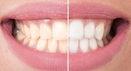 Bleaching -
