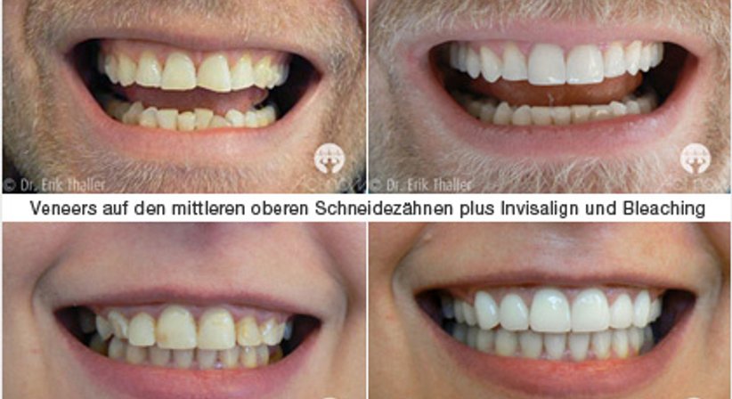 Vollkeramische Kronen / Veneers - Dr. Erik Thaller - Zahnarzt Wien 1050