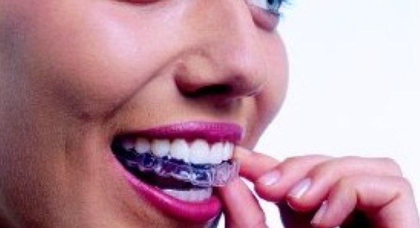 Unsichtbare Zahnregulierung / Invisalign - Dr. Erik Thaller - Zahnarzt Wien 1050