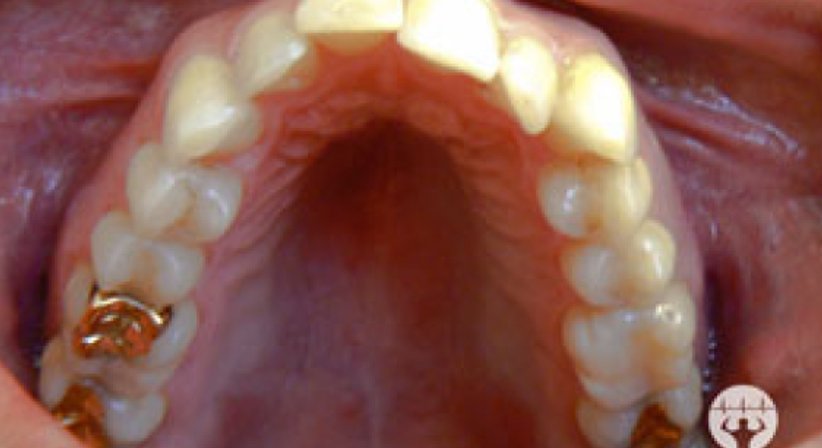 Unsichtbare Zahnregulierung / Invisalign - Dr. Erik Thaller - Zahnarzt Wien 1050