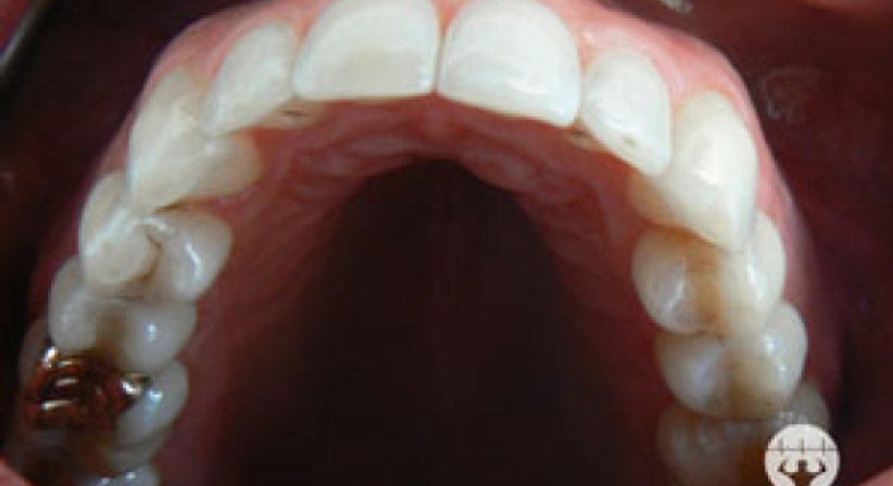 Unsichtbare Zahnregulierung / Invisalign - Dr. Erik Thaller - Zahnarzt Wien 1050