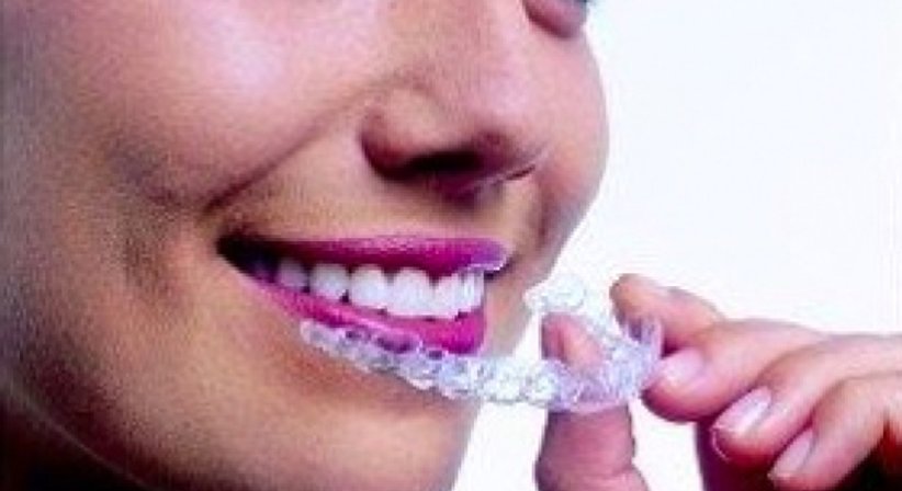 Unsichtbare Zahnregulierung / Invisalign - Dr. Erik Thaller - Zahnarzt Wien 1050
