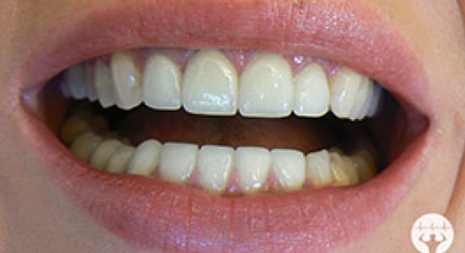 Dr. Erik Thaller Vollkeramische Kronen / Veneers Zahnarzt in 1050 Wien DocFinder.at