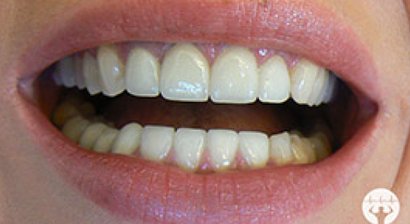 Vollkeramische Kronen / Veneers