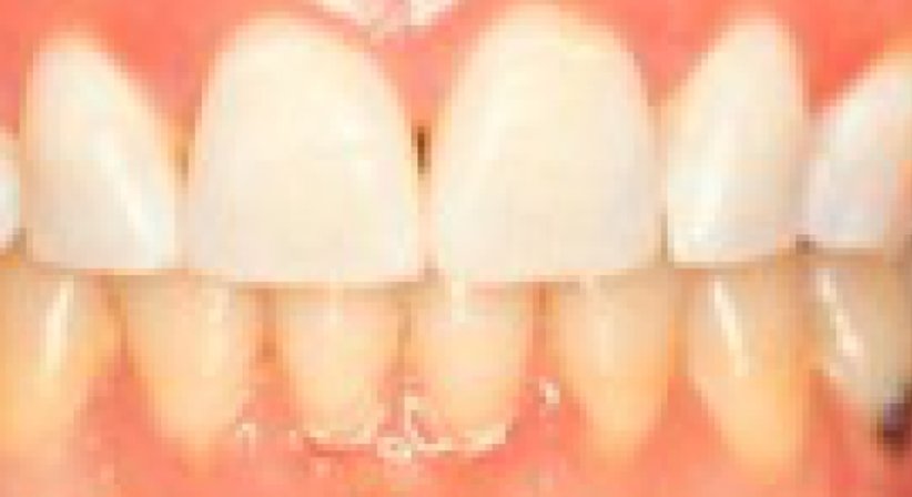 Zähne aufhellen / Bleaching - Dr. Erik Thaller - Zahnarzt Wien 1050