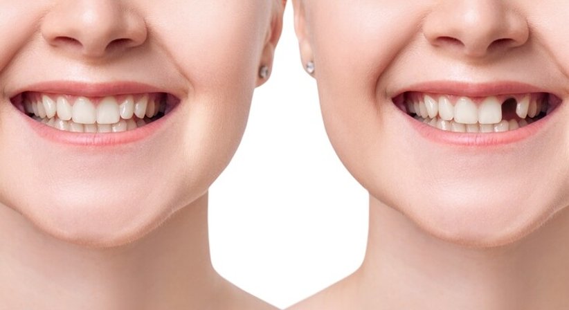 Chirurgische Leistungen & Implantate - Dr. Gustav Niebauer - Zahnarzt Wien 1100