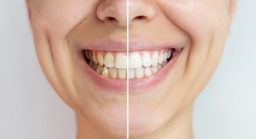 Zahn Bleaching - Dr. Gustav Niebauer - Zahnarzt Wien 1100