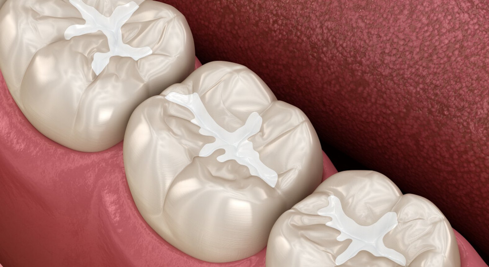 Dr. Günther Schuster Fissurenversiegelungen Zahnarzt in 1140 Wien