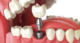 Dr. Günther Schuster - Zahnarzt Wien 1140