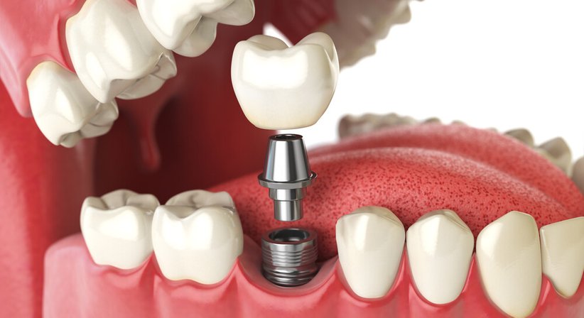 Implantologie - Dr. Günther Schuster - Zahnarzt Wien 1140