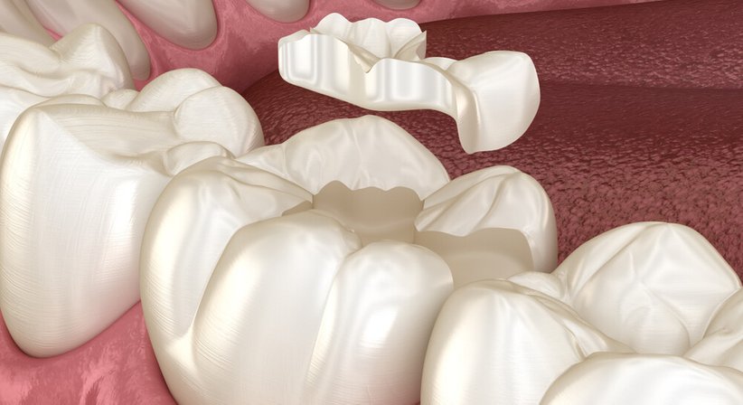 Inlays - Dr. Günther Schuster - Zahnarzt Wien 1140