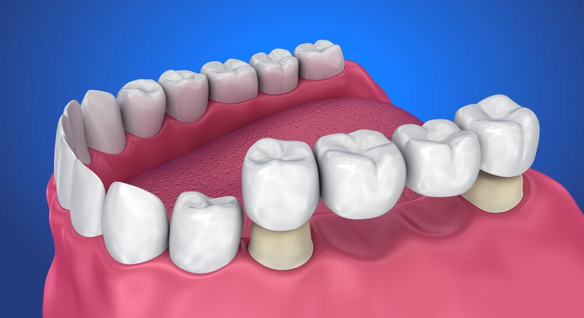 Zahnkronen und –brücken - Dr. Günther Schuster - Zahnarzt Wien 1140
