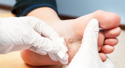 Entfernung von gutartigen Hauttumoren