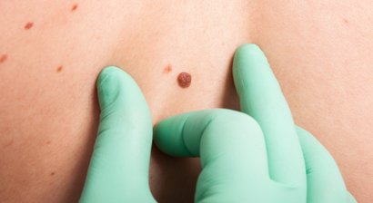 Muttermalkontrolle und Hautkrebsdiagnostik mit digitaler Auflichtmikroskopie (Videodermatoskopie) / Tumorchirurgie