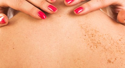 Entfernung von Pigmentflecken / Melasmen