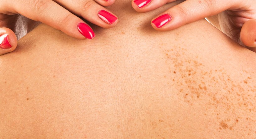 Entfernung von Pigmentflecken / Melasmen - OA Dr. Gregor Holzer - Hautarzt Wien 1010