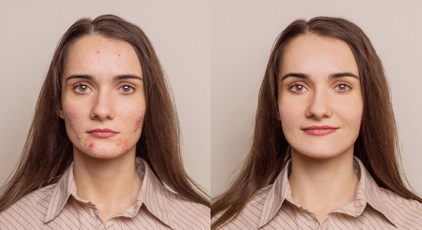 Aknebehandlung - OA Dr. Gregor Holzer - Hautarzt Wien 1010