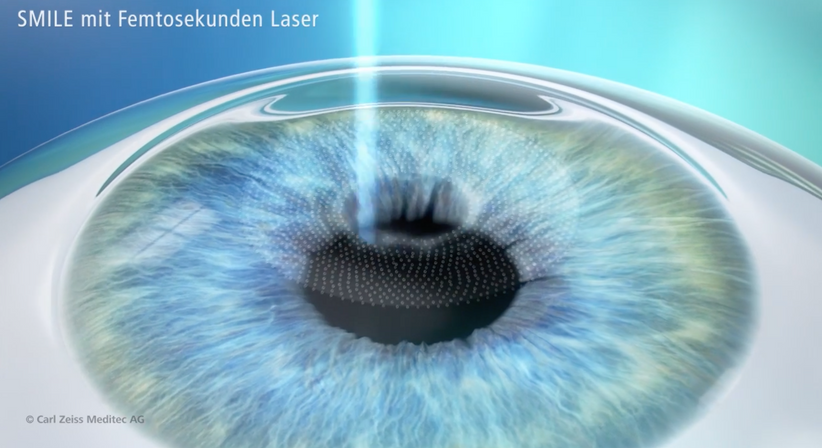 ReLEx® SMILE - Dr. Dino Dolib - Augenarzt Wien 1010