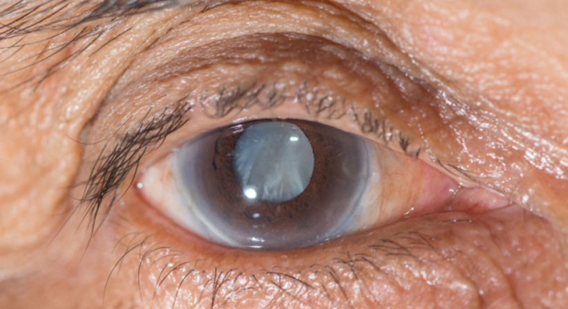 Grauer Star (Katarakt) - Dr. Dino Dolib - Augenarzt Wien 1010