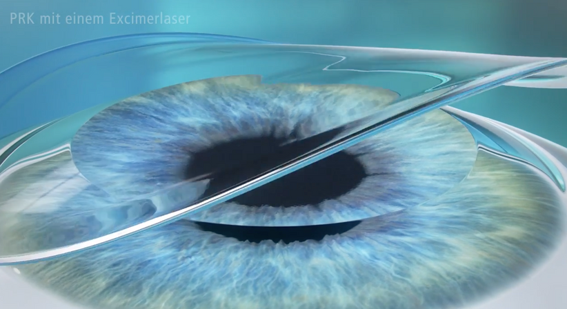 PRK/LASEK - Dr. Dino Dolib - Augenarzt Wien 1010