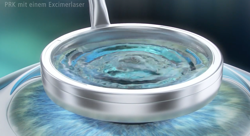 PRK/LASEK - Dr. Dino Dolib - Augenarzt Wien 1010