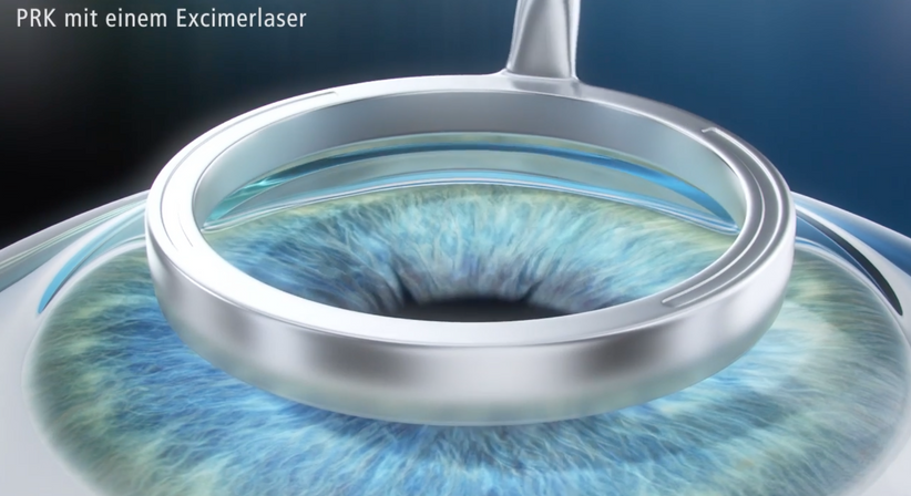 PRK/LASEK - Dr. Dino Dolib - Augenarzt Wien 1010