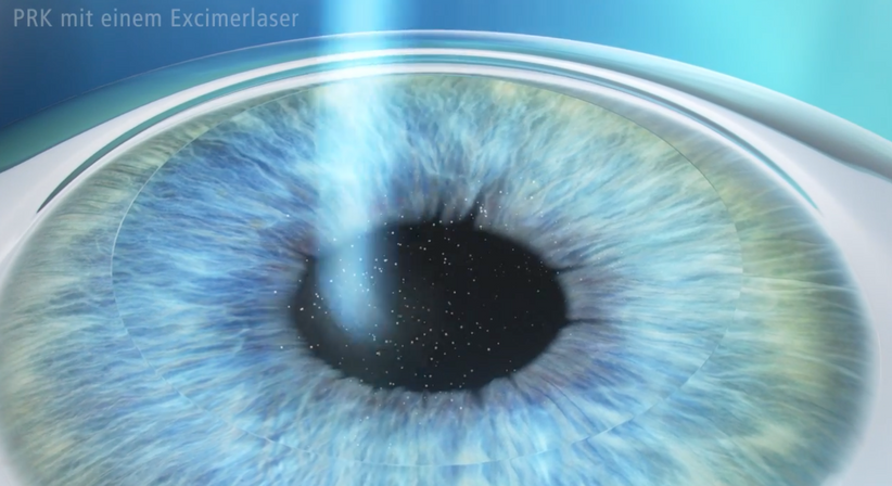 PRK/LASEK - Dr. Dino Dolib - Augenarzt Wien 1010