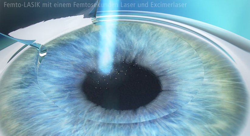Femto LASIK - Dr. Dino Dolib - Augenarzt Wien 1010