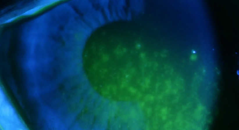 Trockenes Auge (Sicca-Syndrom) - Dr. Dino Dolib - Augenarzt Wien 1010