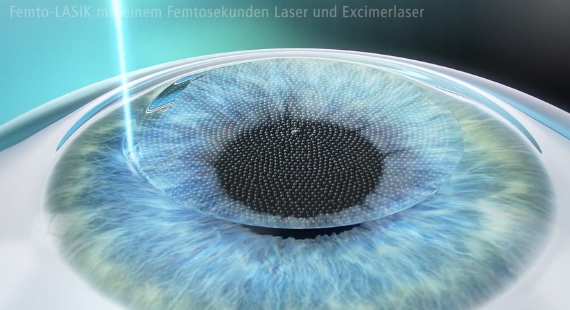 Femto LASIK - Dr. Dino Dolib - Augenarzt Wien 1010
