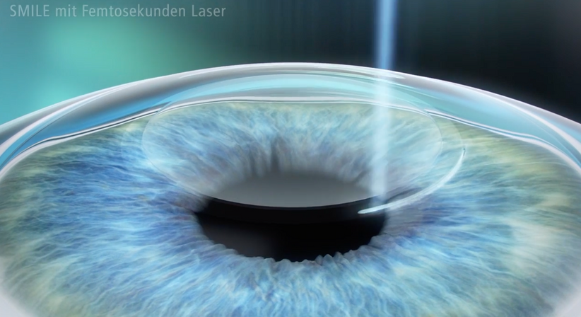 ReLEx® SMILE - Dr. Dino Dolib - Augenarzt Wien 1010