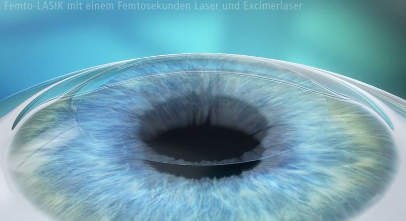 Femto LASIK - Dr. Dino Dolib - Augenarzt Wien 1010