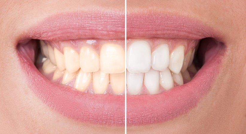 Bleaching - Dr. Pastorel Gorea - Zahnarzt Wien 1100