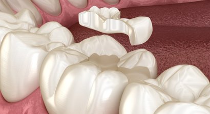 Inlay, Onlay, Zahnfüllungen