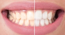 Bleaching -