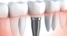 Implantologie und Prothetik -