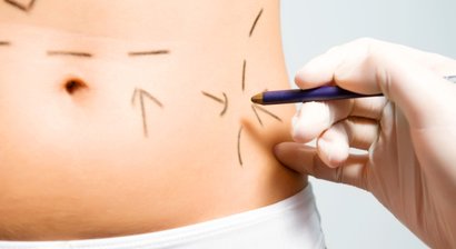 Bauchdeckenstraffung