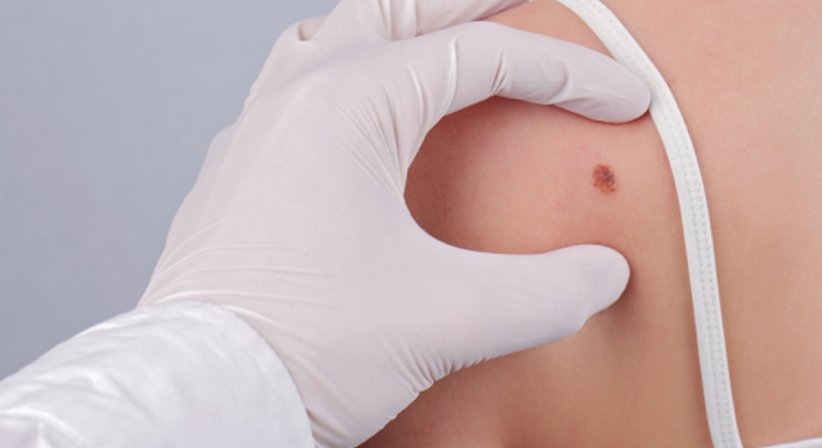 Hauttumor - OA Dr. Albert Feichter - Plastischer Chirurg Wien 1060