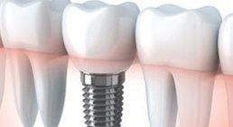Implantate -