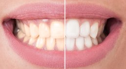 Bleaching -