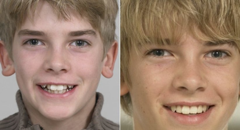 Gratis Zahnspange - Dr. med. dent. Guido Sampermans - Zahnarzt Wien 1140