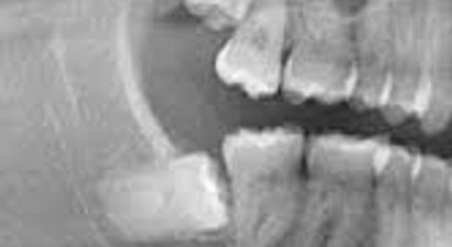 Operative Weisheitszahnentfernung