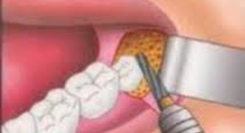 Operative Weisheitszahnentfernung - DDr. Barbara Ferra - Zahnärztin Graz 8010