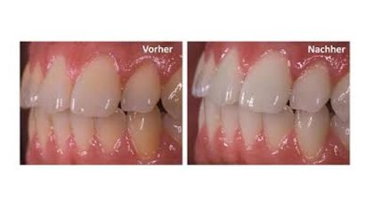 Professionelle Zahnaufhellung - Bleaching